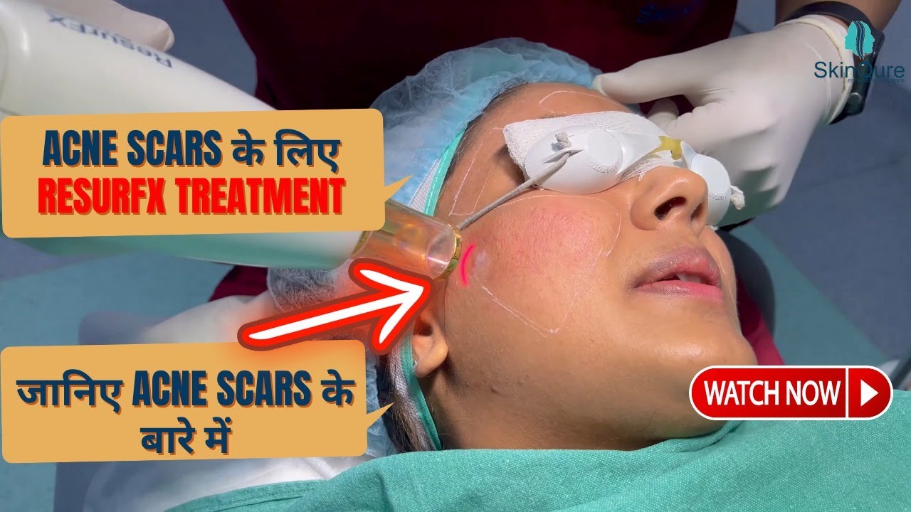 ResurFx Treatment for Acne Scars,  Know all about Acne Scars and its effective treatment | SkinQure