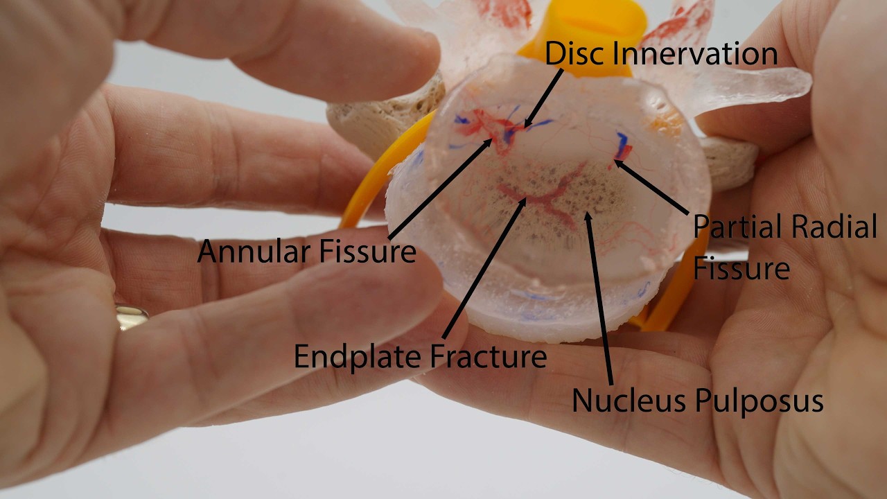 Professional LxH Dynamic Disc Model | Lumbar Spine Education by Dynamic Disc Designs