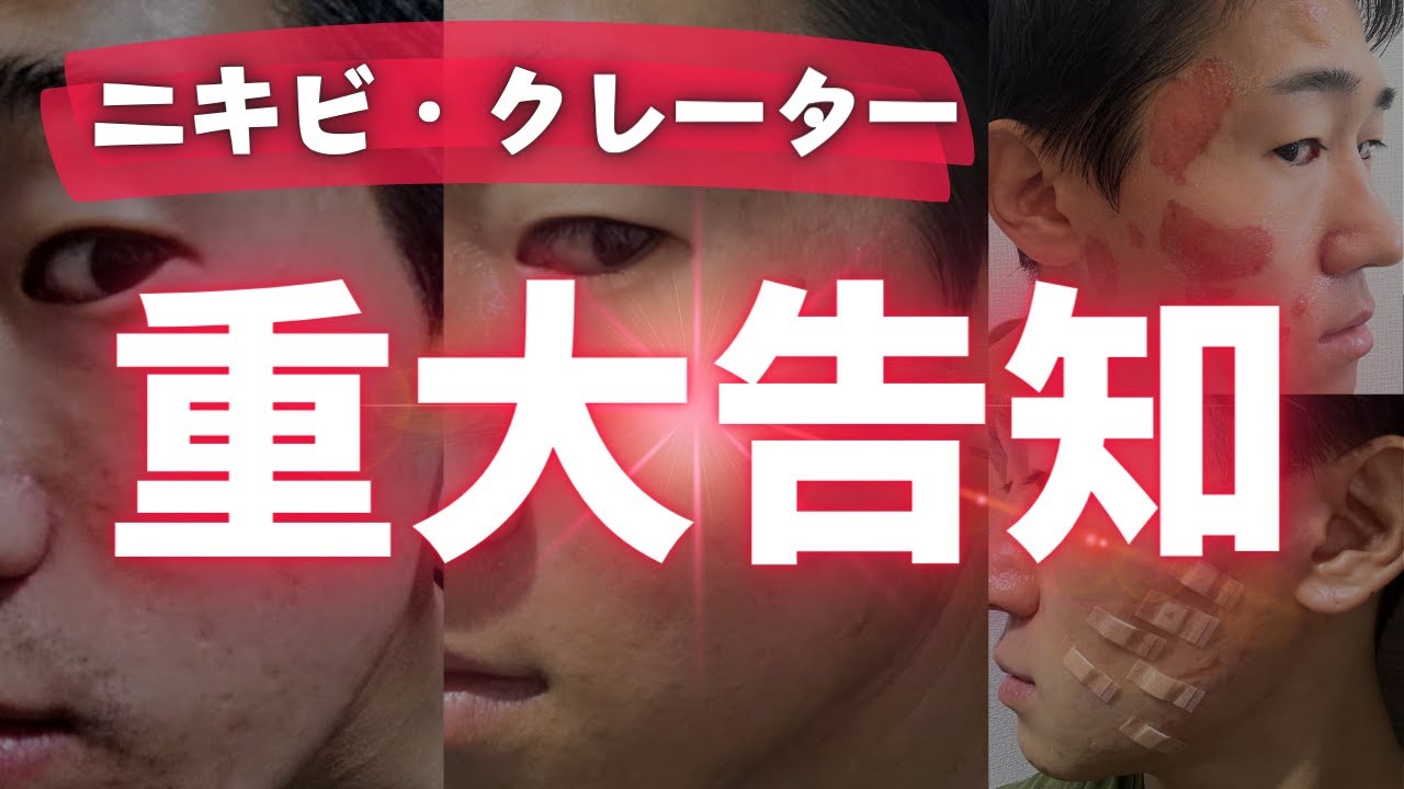 【重大告知】ニキビ・クレーター肌の治療についてご報告があります。