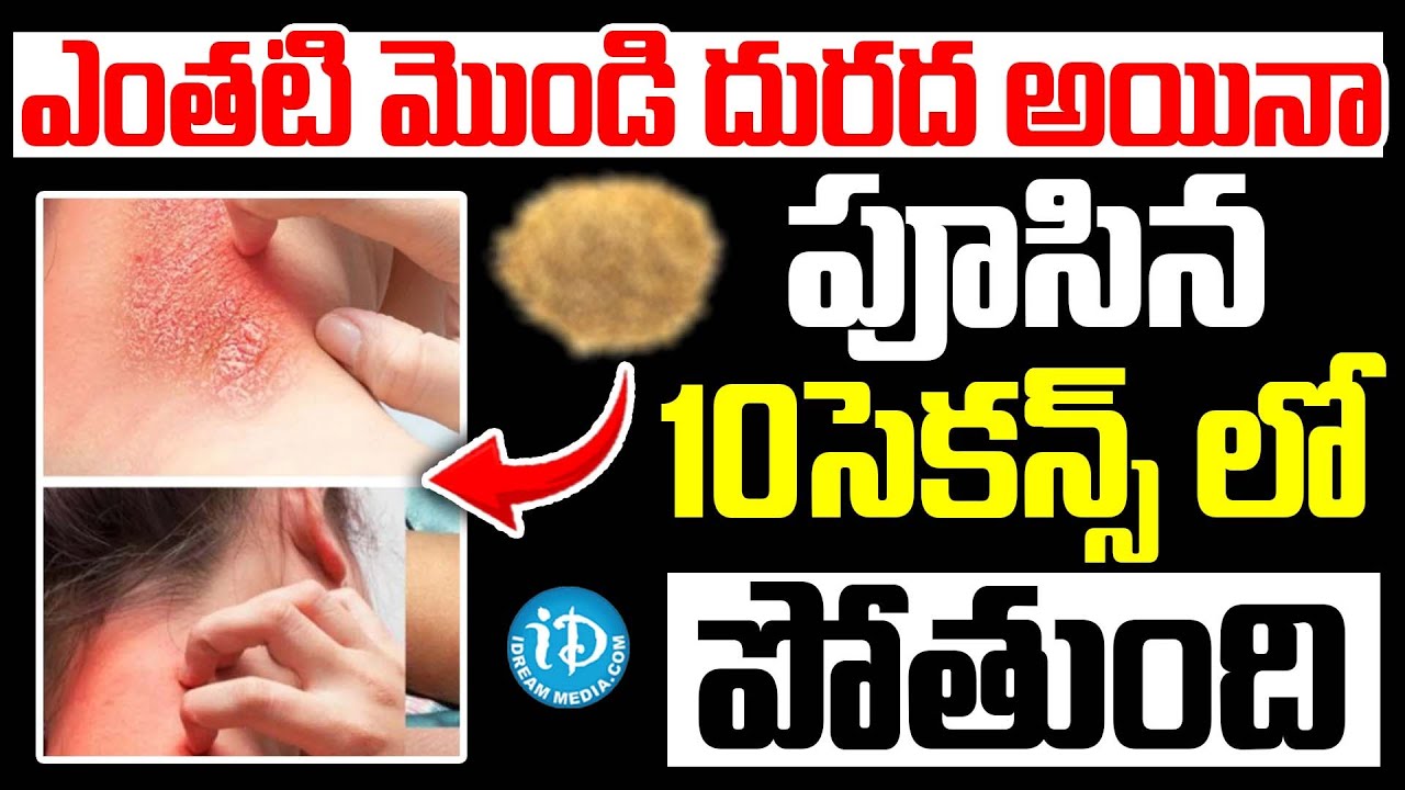 Skin Allergy Home remedy| ఎంతటి మొండి దురద అయినా పూసిన 10సెకన్స్ లో పోతుంది | Dr. Madhusudana Sharma