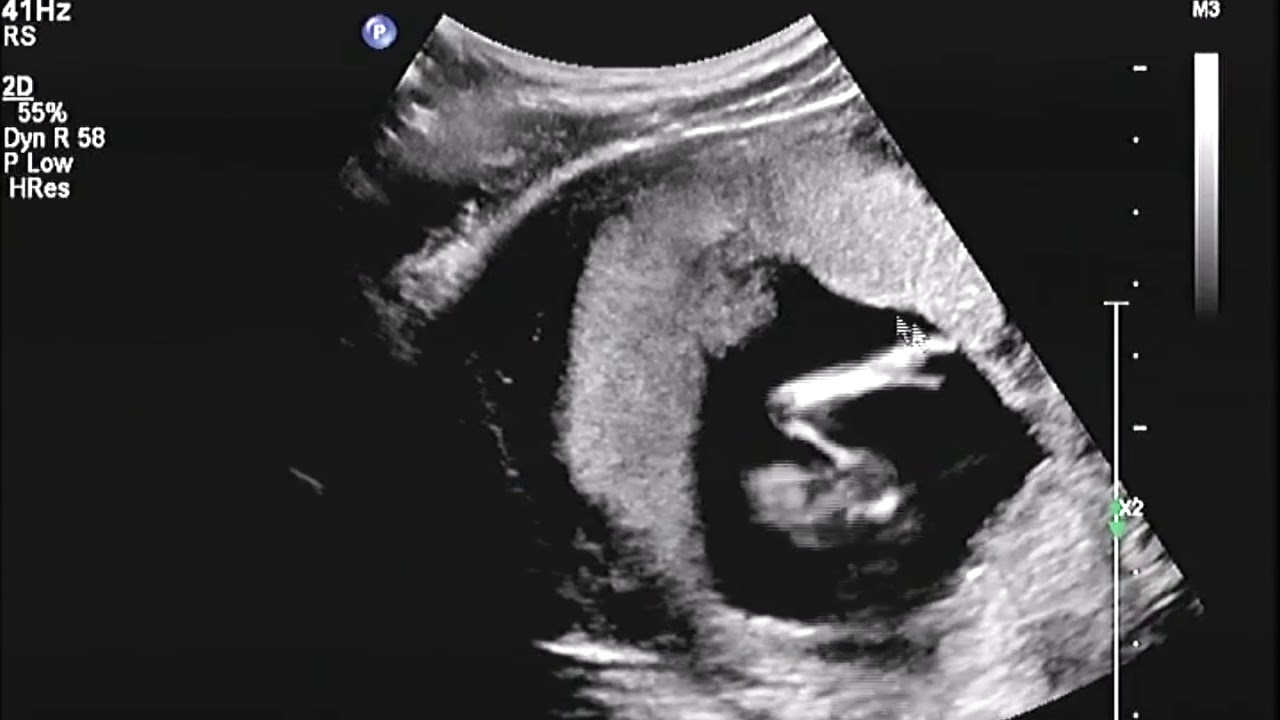 2D Echo 13 Weken Geslachtsbepaling Jongen, met ingesproken uitleg