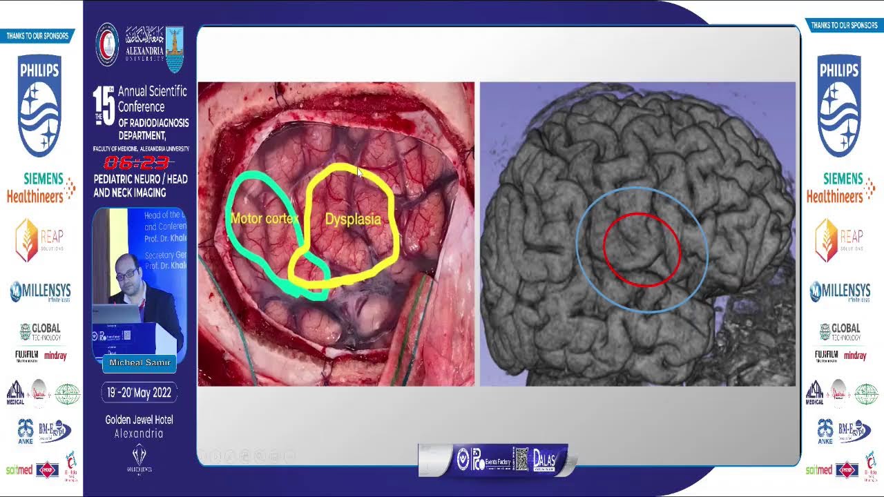 Imaging in pediatric epilepsy: preoperative cases selection