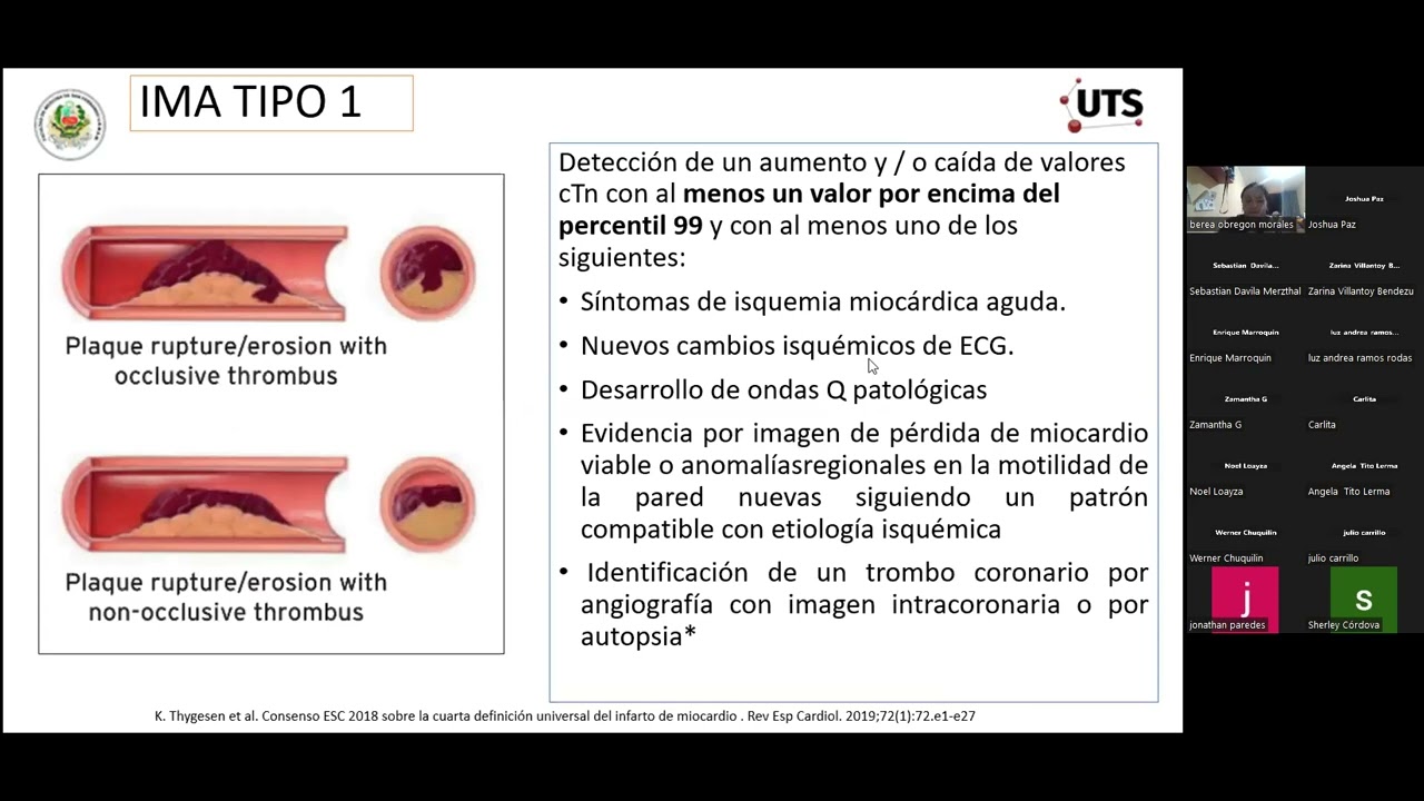 Cuarta definici&oacute;n de Infarto agudo al miocardio