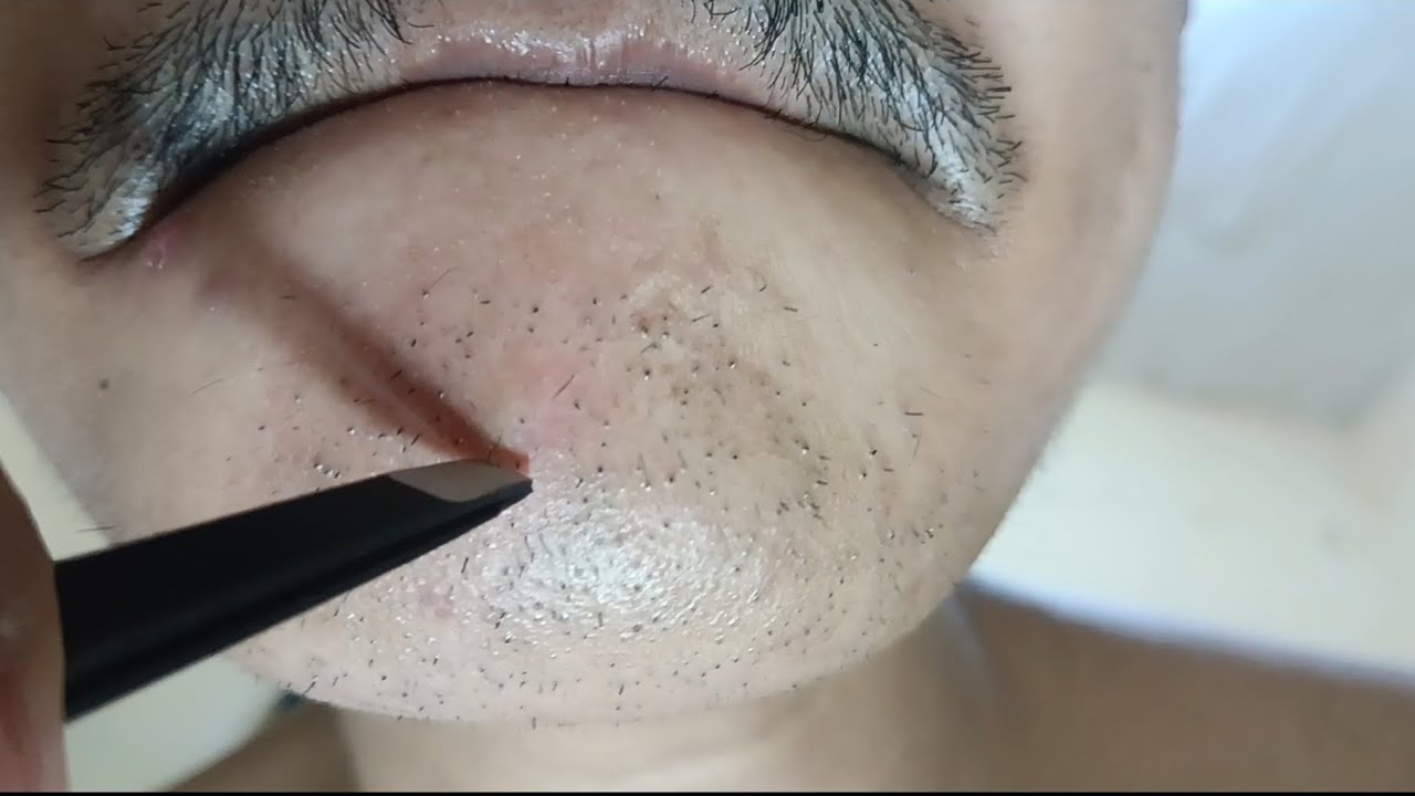 Momen melegakan, kegiatan mencabut rambut jenggot/bulu dagu #6 #hairremoval #tweezer #plucking 