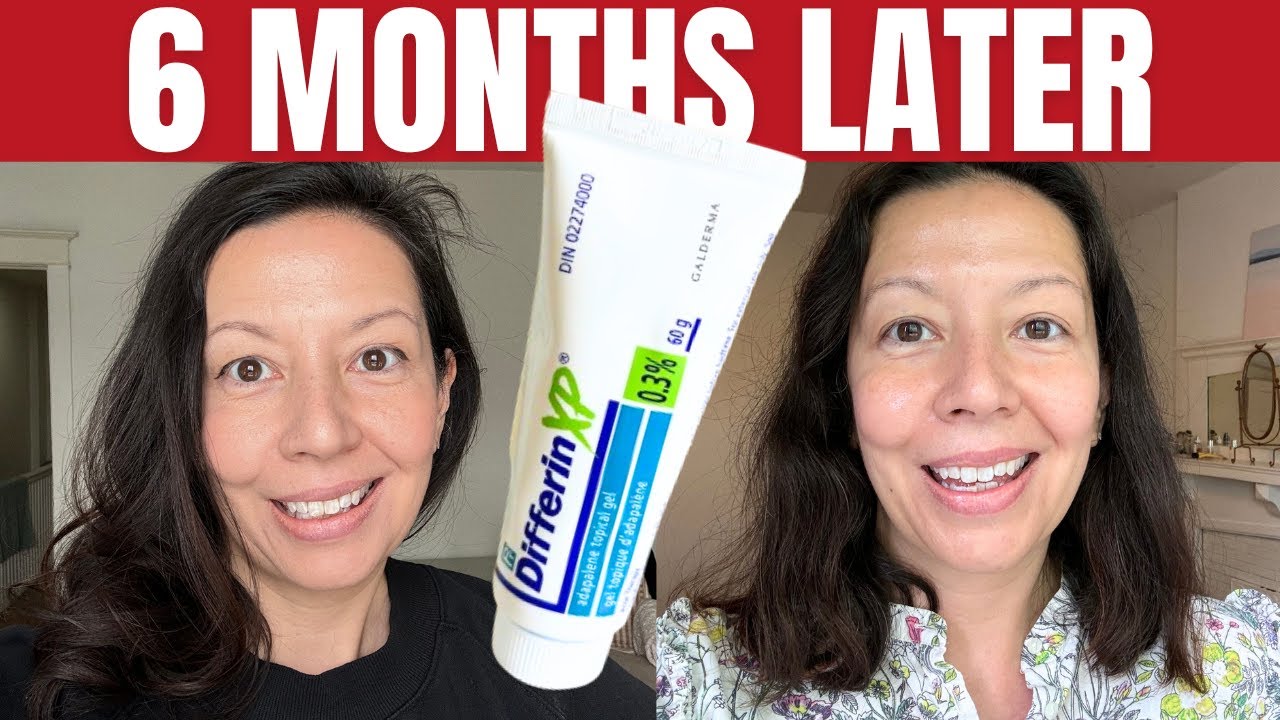 Differin XP Gel 0.3 Review For Adult Acne, Hyperpigmentation and Wrinkles