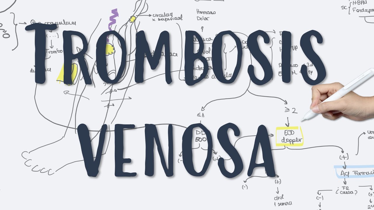 TROMBOSIS VENOSA #Profunda #Superficial  #TVP #TVS #Flegmasia #Flebitis