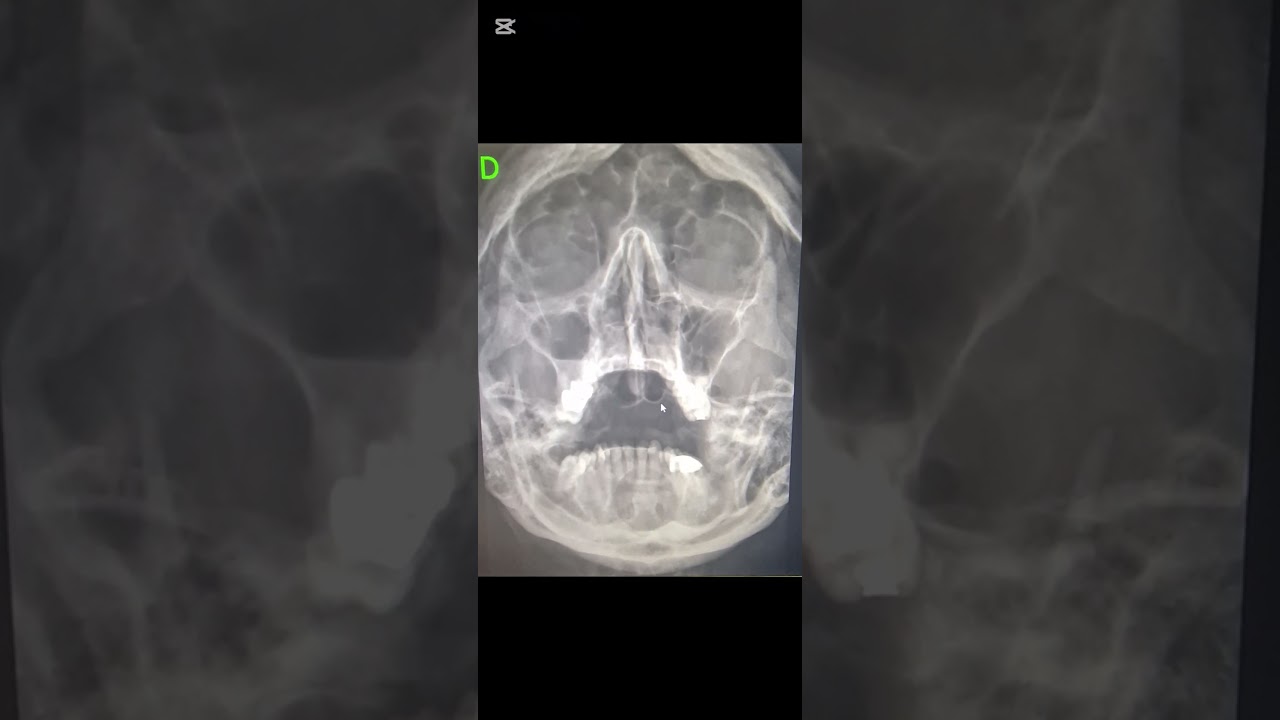 Radiographie du blondeau.