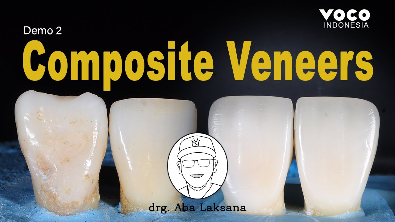 Anterior Composite Veneers Restoration with Layering Technique | AMARIS, VOCO GmbH