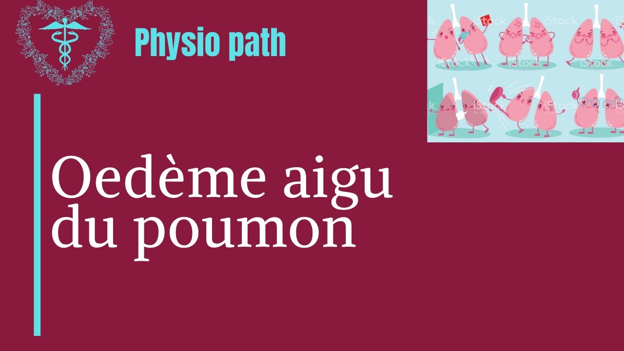 OAP oed&egrave;me aigu du poumon
