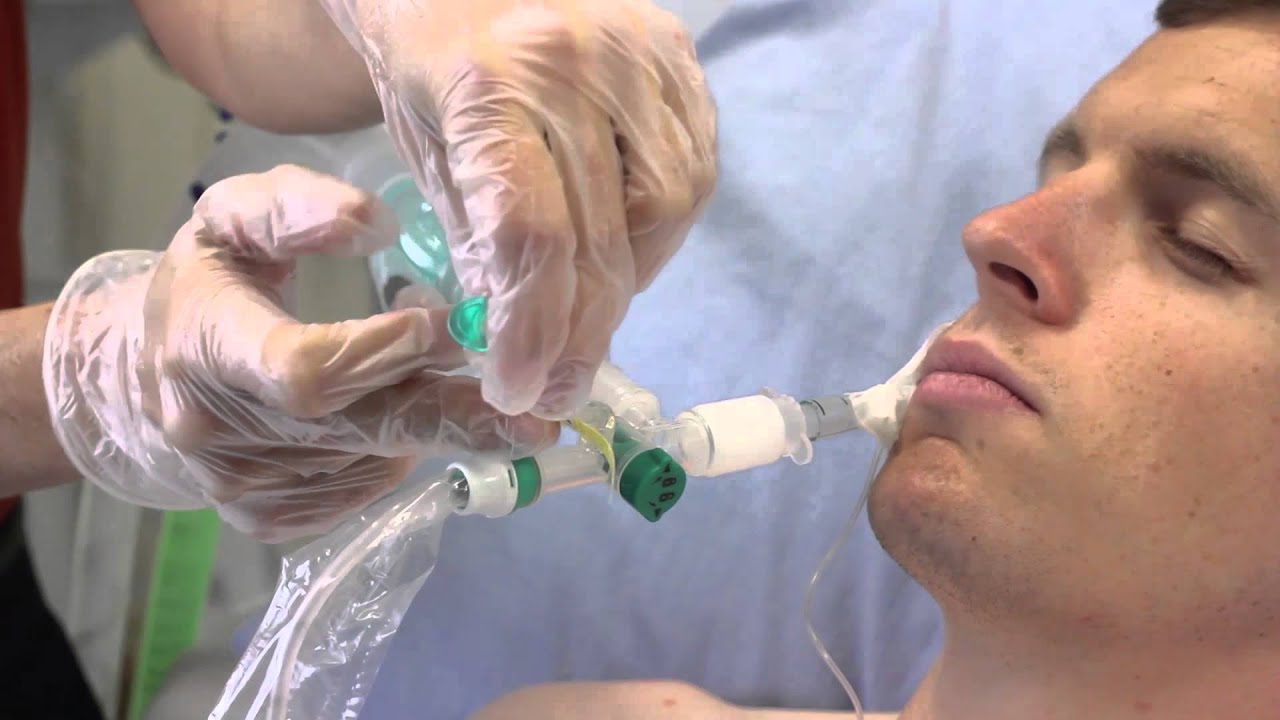 Intersurgical TrachSeal™Odsávací uzavretý systém