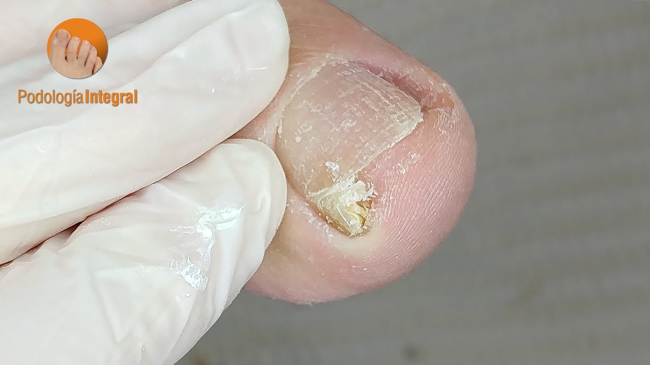 Bye bye nail discomfort! Welcome total cleaning! [Podolog&iacute;a Integral]