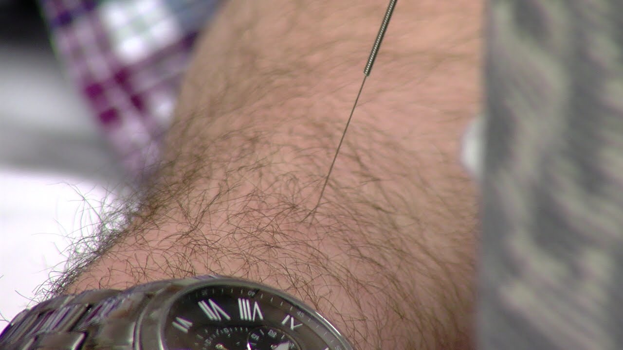 Study: Acupuncture works as well as medicine for chronic pain in some
