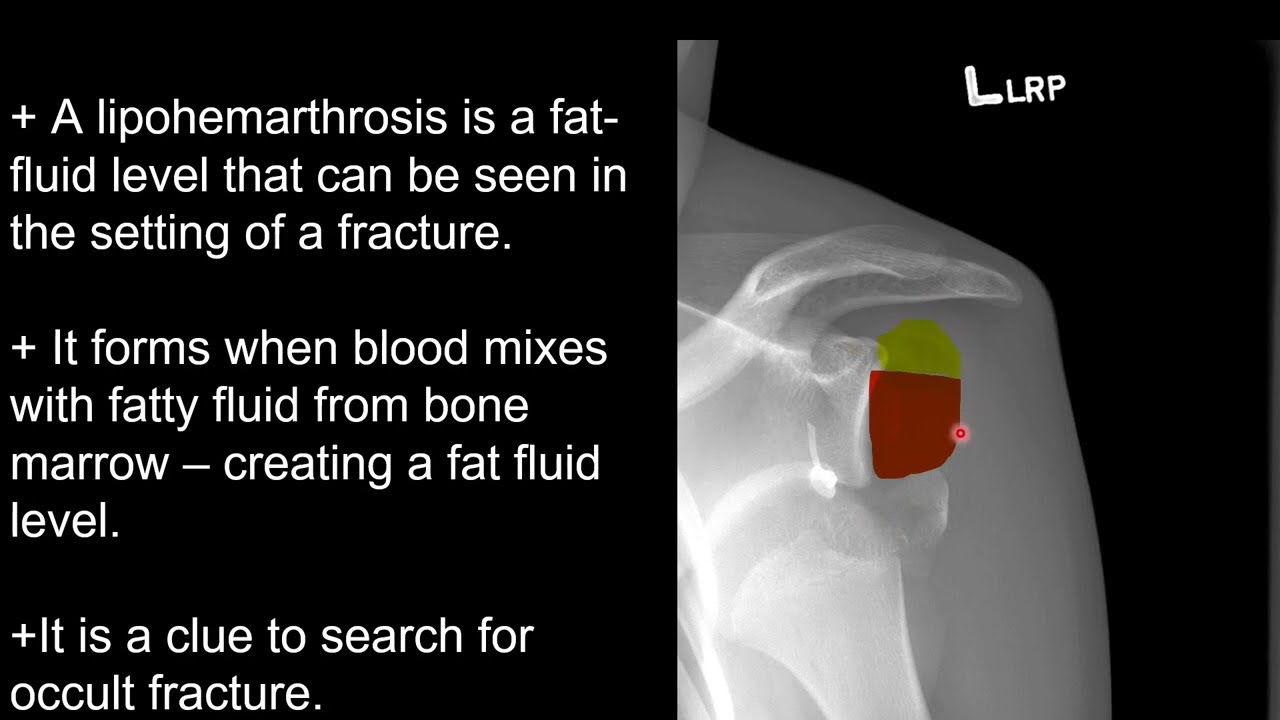 Shoulder X-Ray: Shoulder Dislocation and Complications