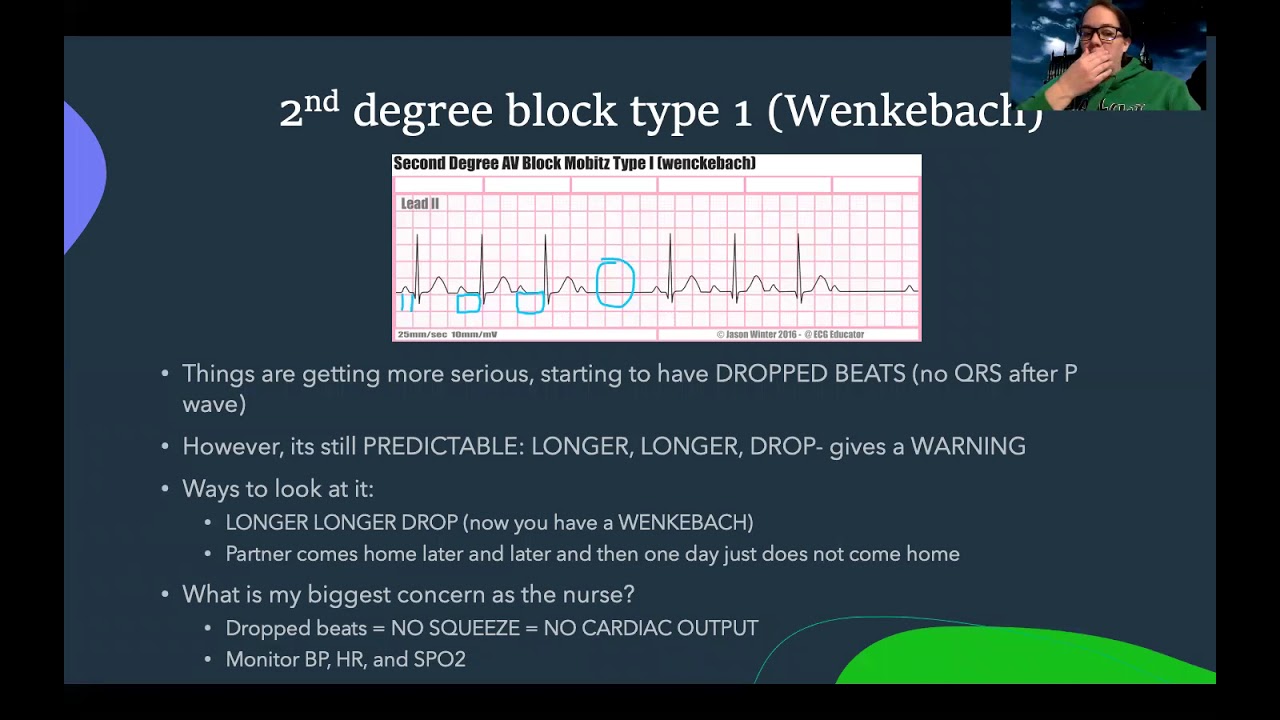 Complex EKG: Heart Blocks