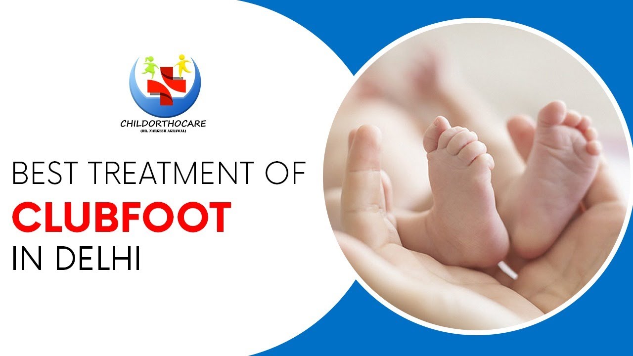 Child Ortho care- Successful clubfoot treatment by- Dr. Nargesh Agarwal