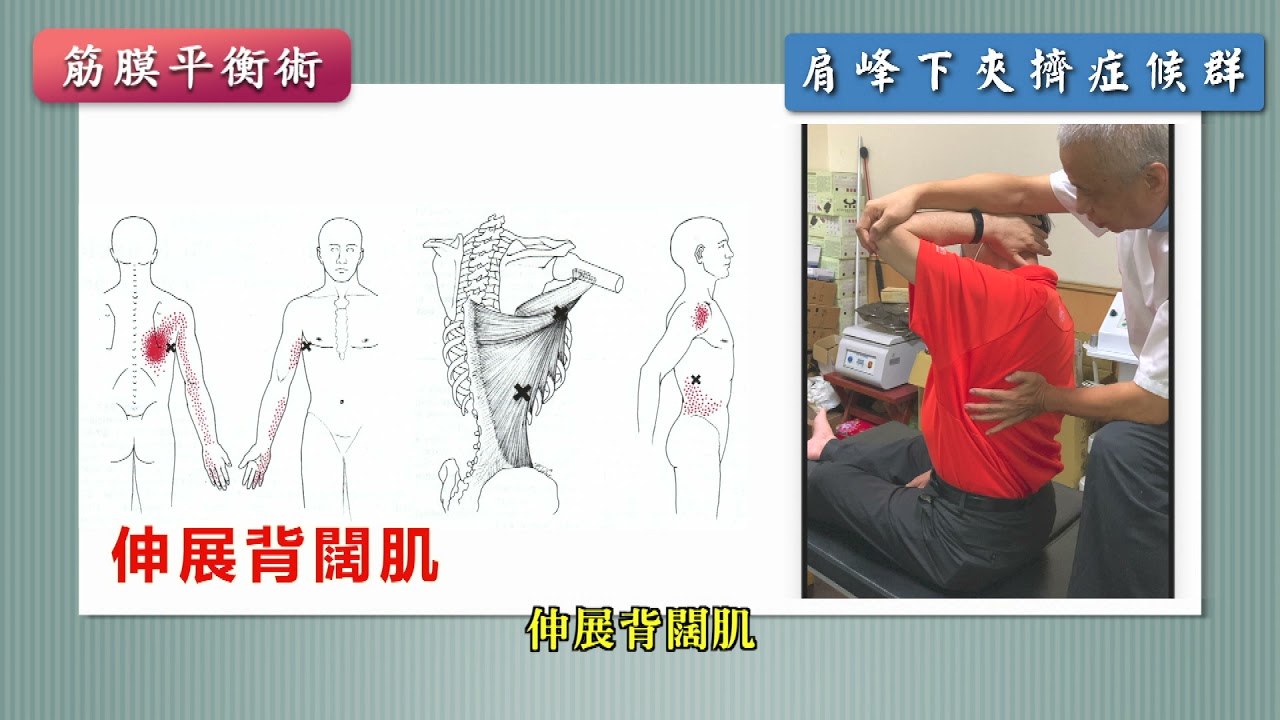 肩膀痛 60％是肩峰下夾擠症候群，肩峰下夾擠症候群如何治療！60% shoulder pain is subacromial pinching syndrome. treat it