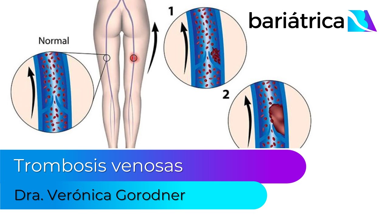 Trombosis venosas y cirugía bariátrica