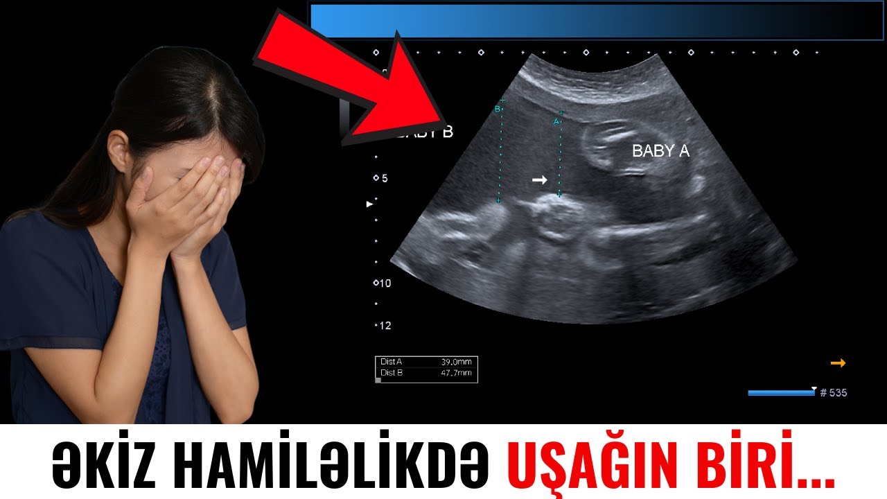 Əkiz hamiləlikdə uşağın biri inkişafdan qaldıqda nə etmək lazımdır?