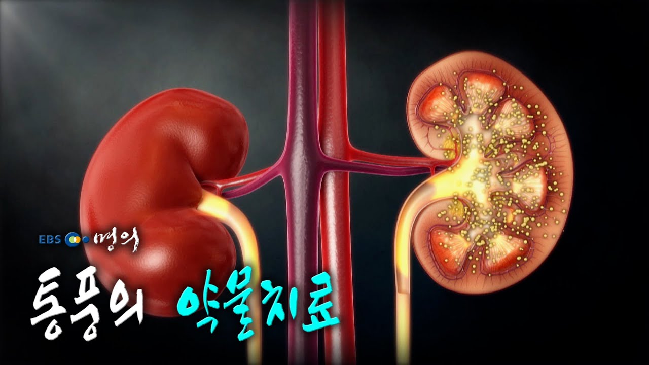 [명의 의학백과📖] 통풍의 약물치료