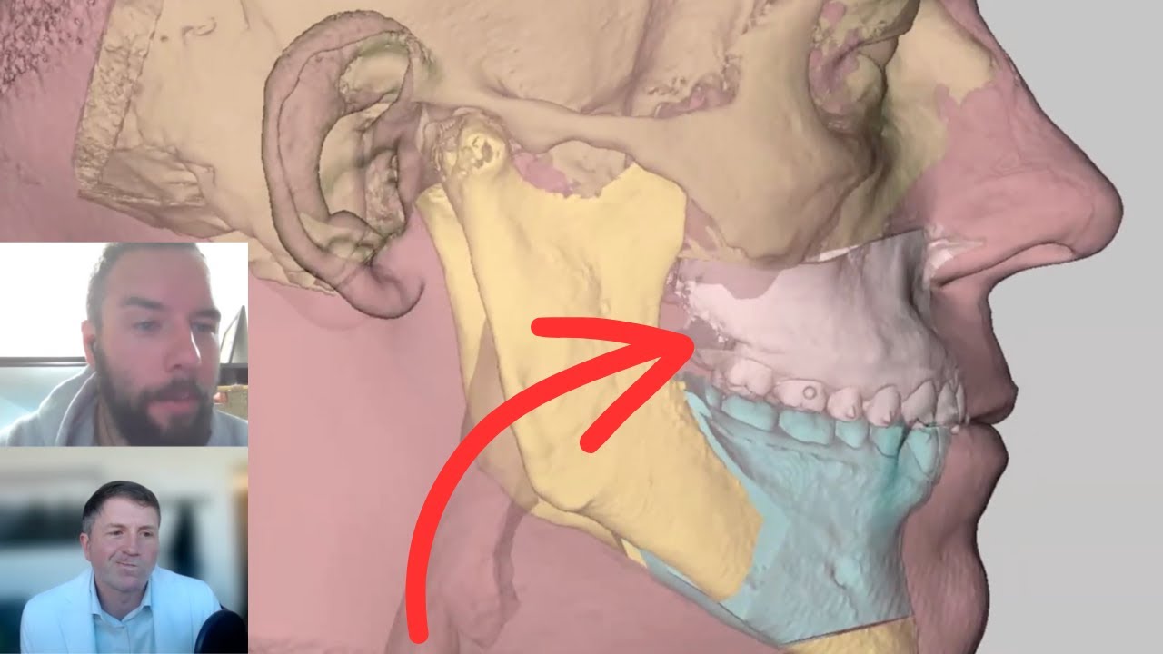 Choosing my Sleep Apnea jaw surgery plan with Dr. Sam Bobek