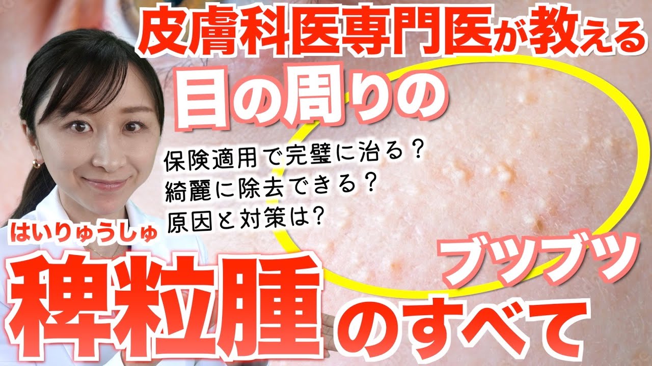 【実は簡単！】皮膚科専門医が教える目の周りのブツブツ「稗粒腫」の治し方と予防法