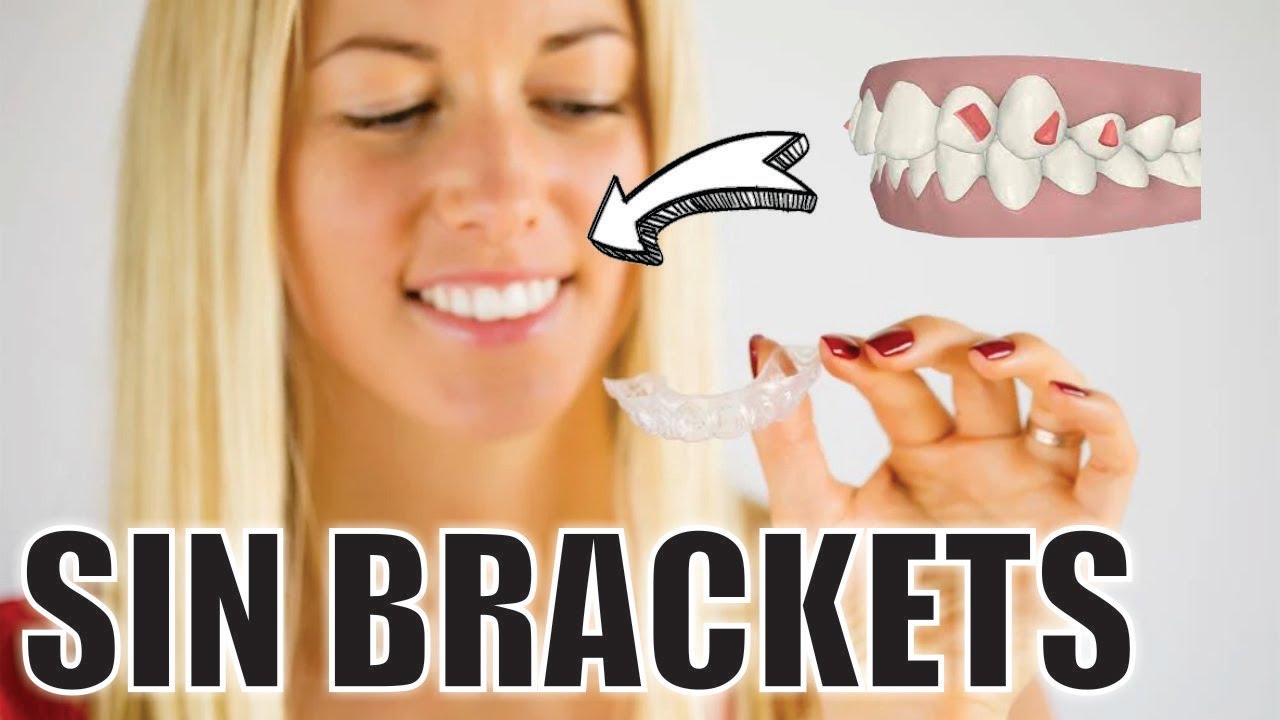 ¿CÓMO funciona el INVISALIGN? 🦷 ATACHES o ATTACHMENTS 😬 ORTODONCIA SIN BRACKETS 🦷 SANTIAGO BURGA 3D