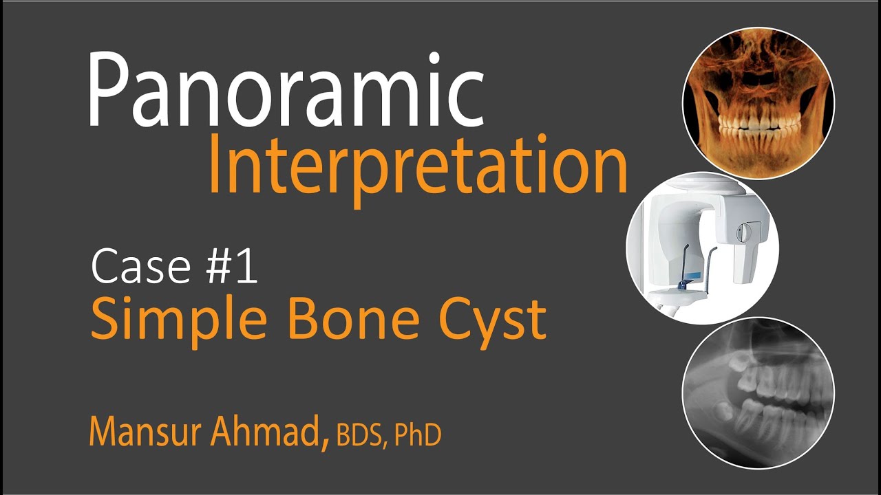 Simple Bone Cyst: Panoramic Radiographic Interpretations