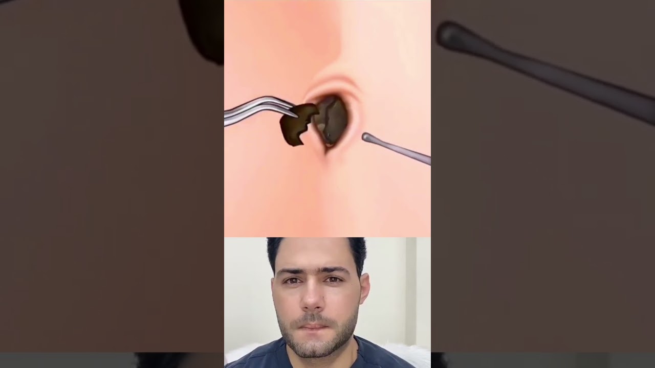 تنظيف السرة #اكسبلور