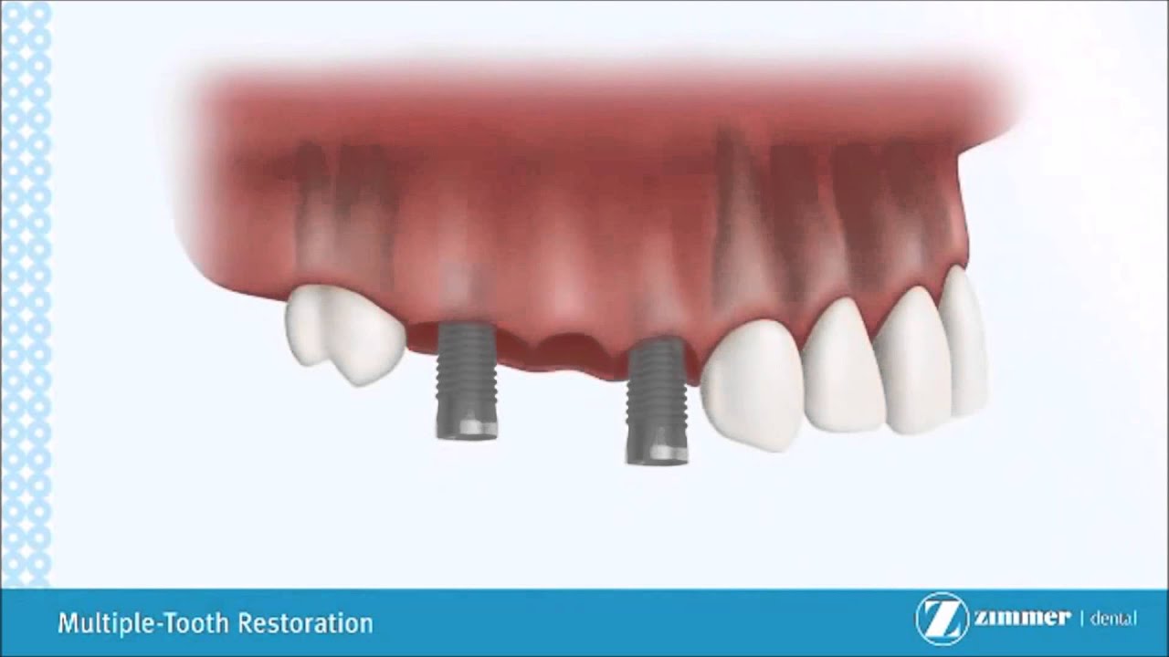 Multiple tooth restauration with dental implant Clinica Artica