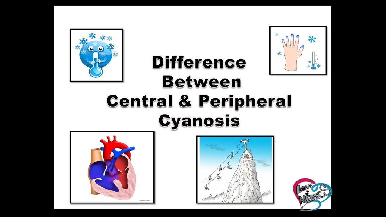 DIFFERENCE BETWEEN CENTRAL CYANOSIS & PERIPHERAL CYANOSIS in tamil|| types of cyanosis || cyanosis