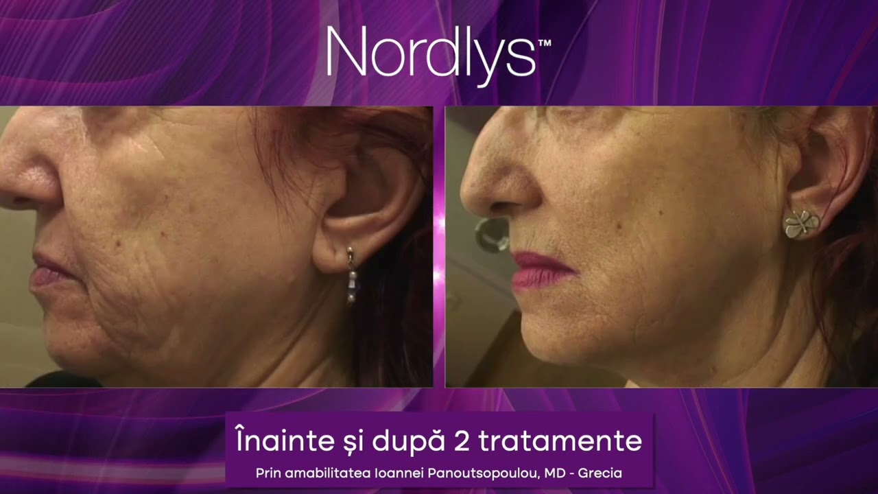 Tratament Laser Antirid
