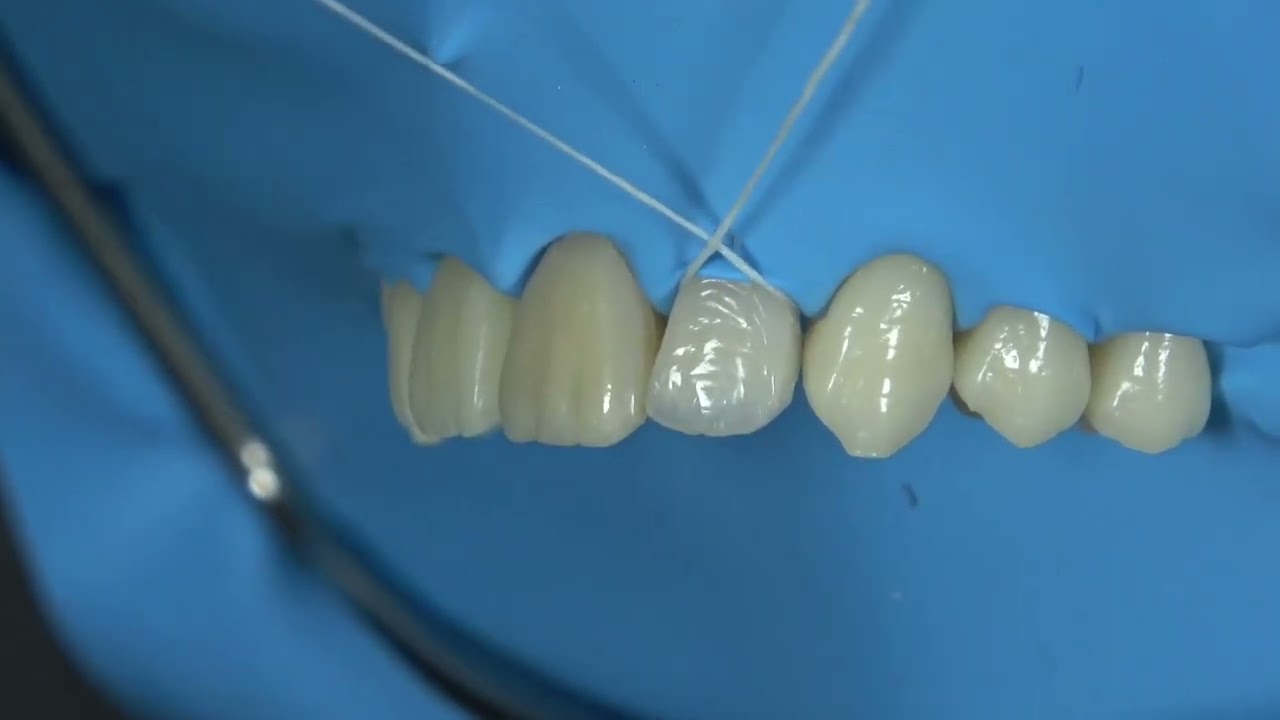 Uso de Hilo en Aislamiento Absoluto