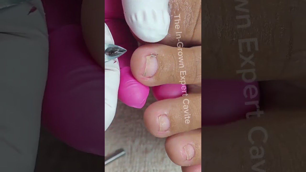 Full video pedicure with ingrown removal 