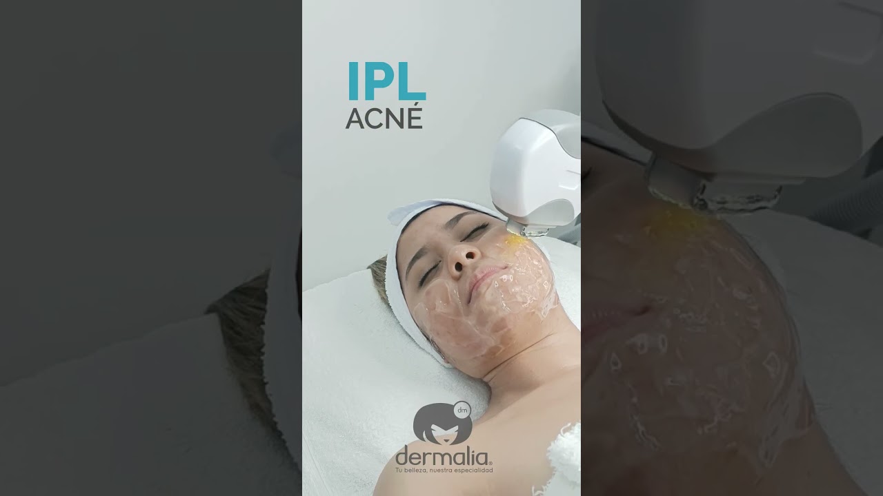 IPL ACNÉ