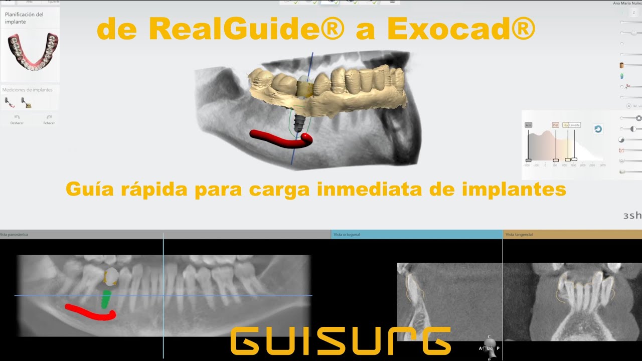Carga Inmediata de Implantes: De Realguide® a Diseño en Exocad®