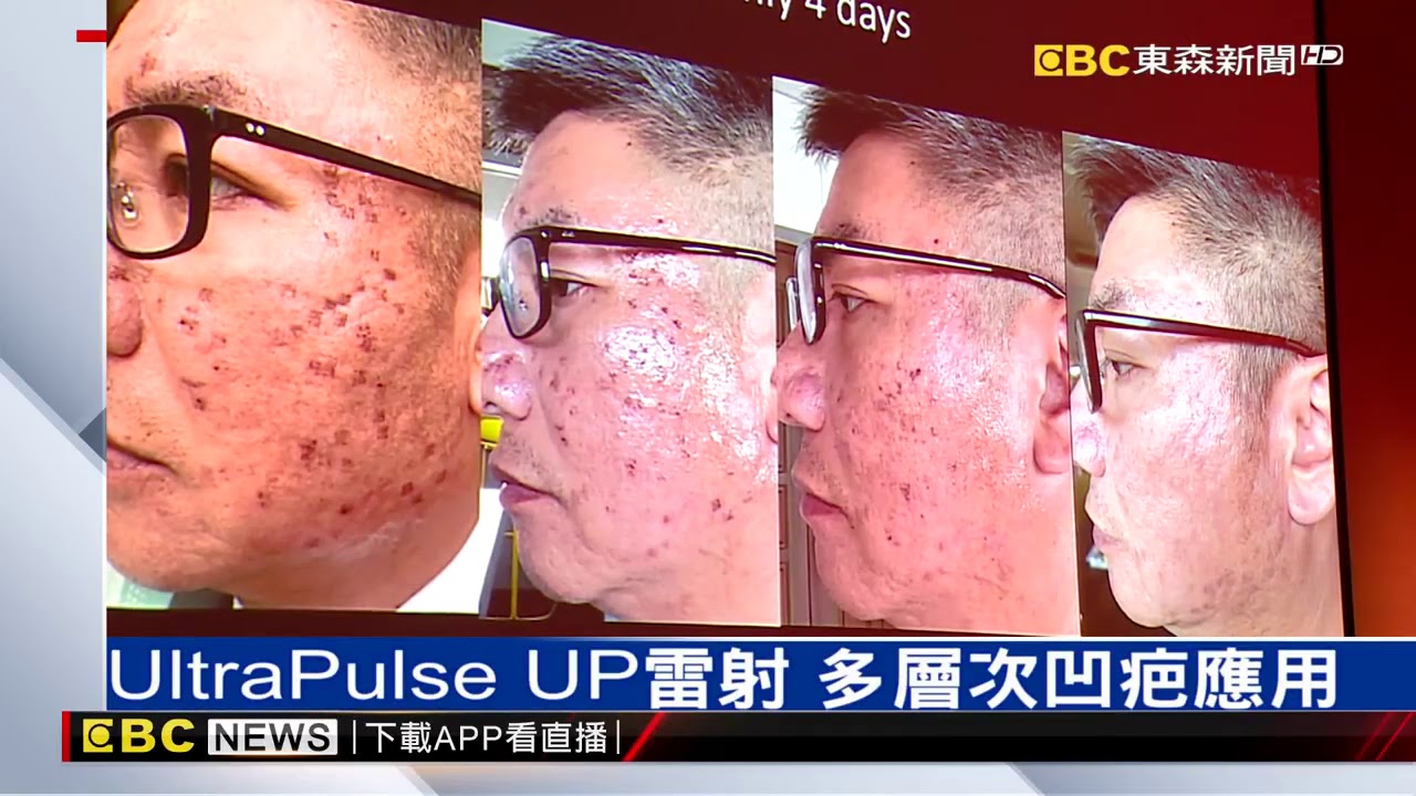 【新聞分享】UltraPulse UP雷射 多層次痘疤應用