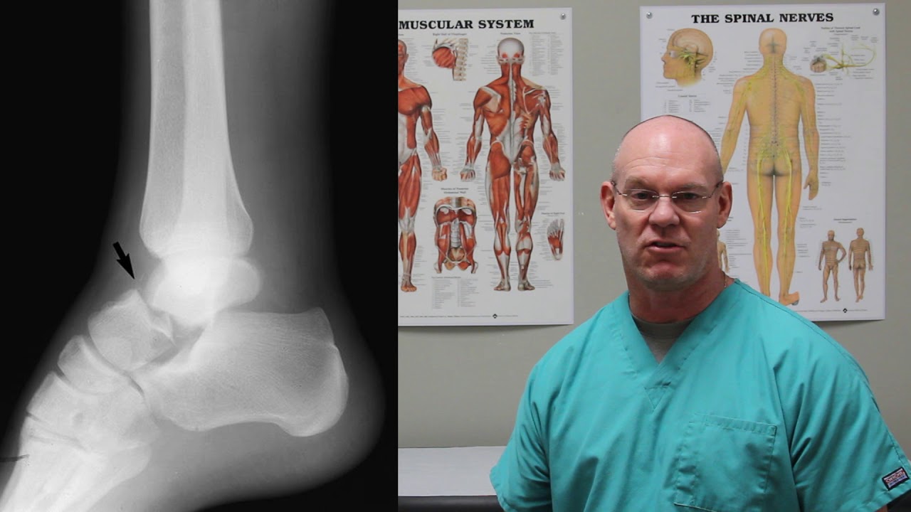 Talus Fracture | Fracture Friday Episode 32
