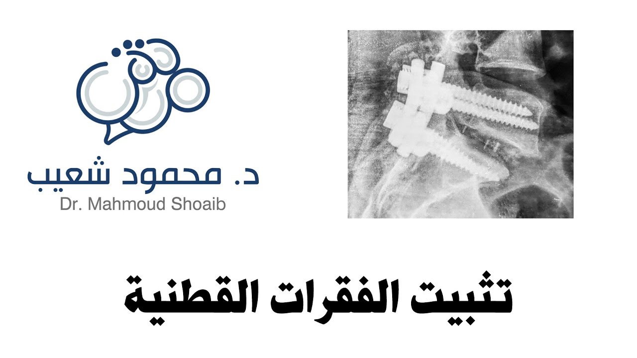 تثبيت الفقرات القطنية - د. محمود شعيب