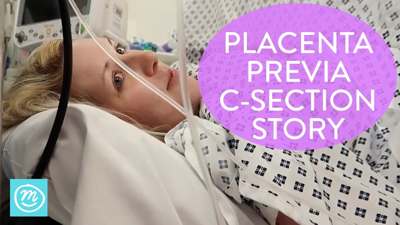Placenta Previa C-Section Birth Story | Channel Mum