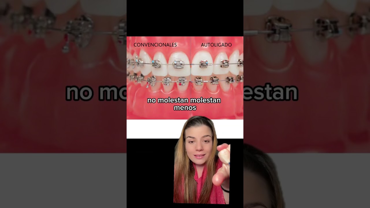 Brackets de autoligado 🦷✅ #shortvideo #shorts #dentista #ortodoncia #brackets