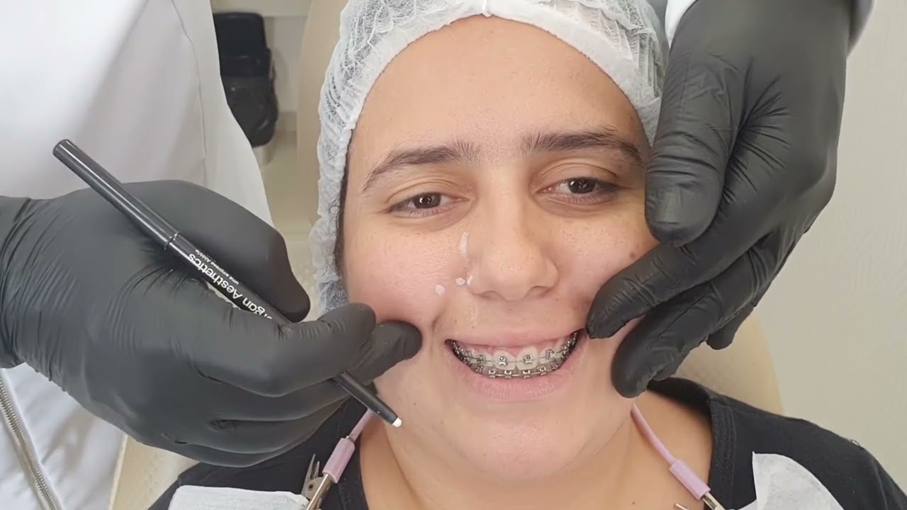 Classificação Sorriso Gengival- Dr.Mizael Silveira