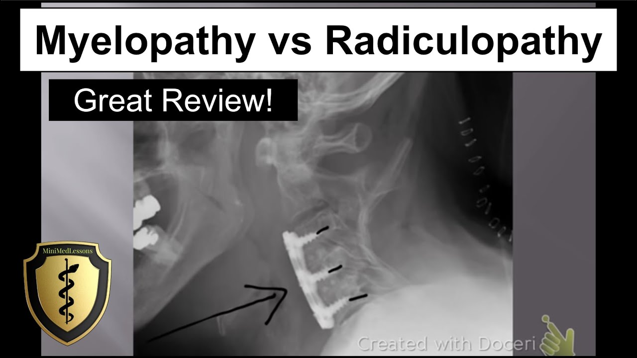 Myelopathy vs Radiculopathy - Great Review!