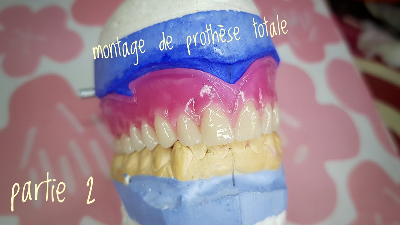 montage de prothèse totale sup partie 2 ( block postérieur )