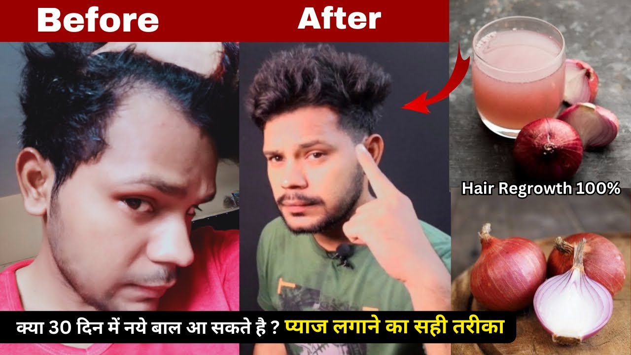30 Days Challenge: Regrowth Hair| How To Use Onion Juice For Hair Regrowth/Dandruff/Extreme Hairfall