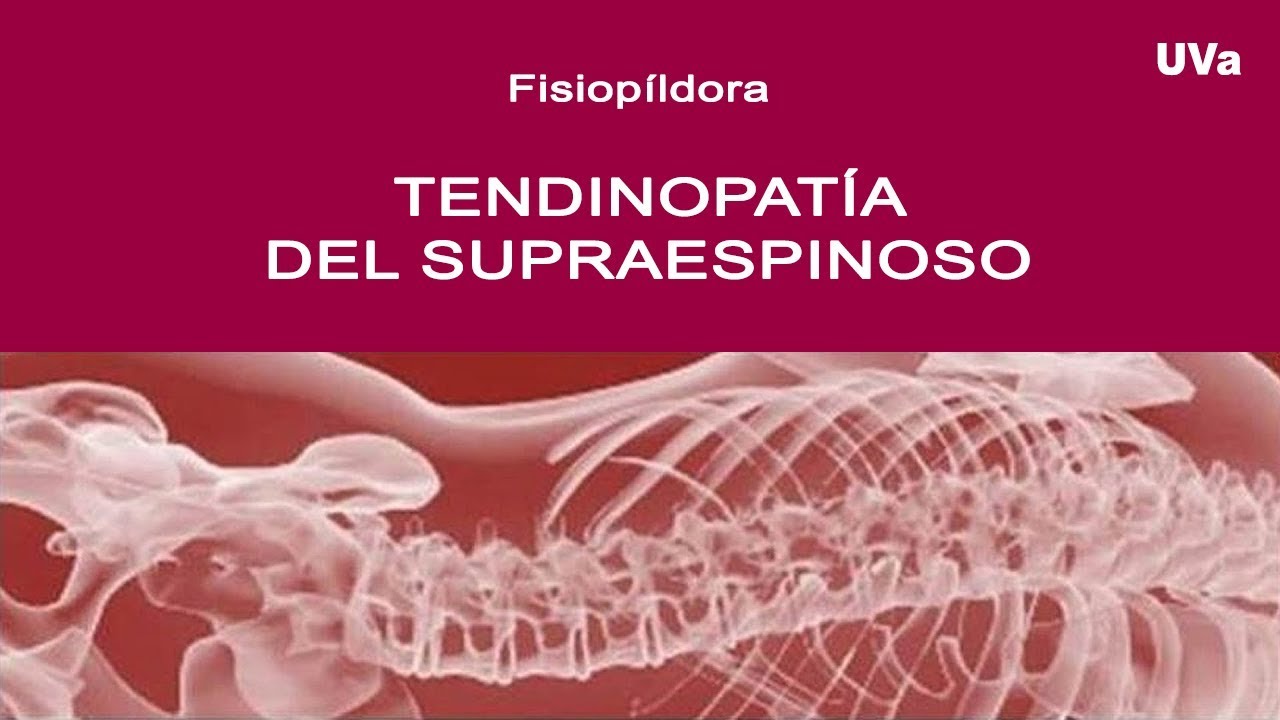 TENDINOPATIA DEL SUPRAESPINOSO