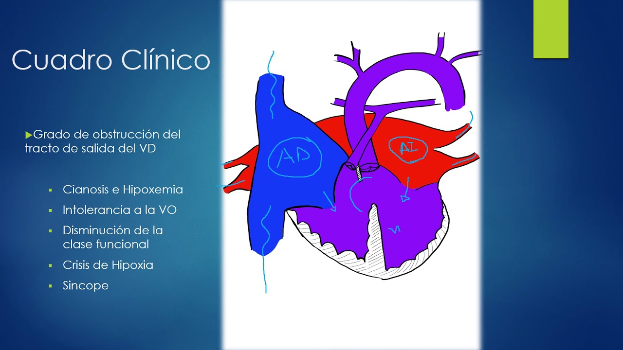 ANESTESIA EN TETRALOGIA DE FALLOT.