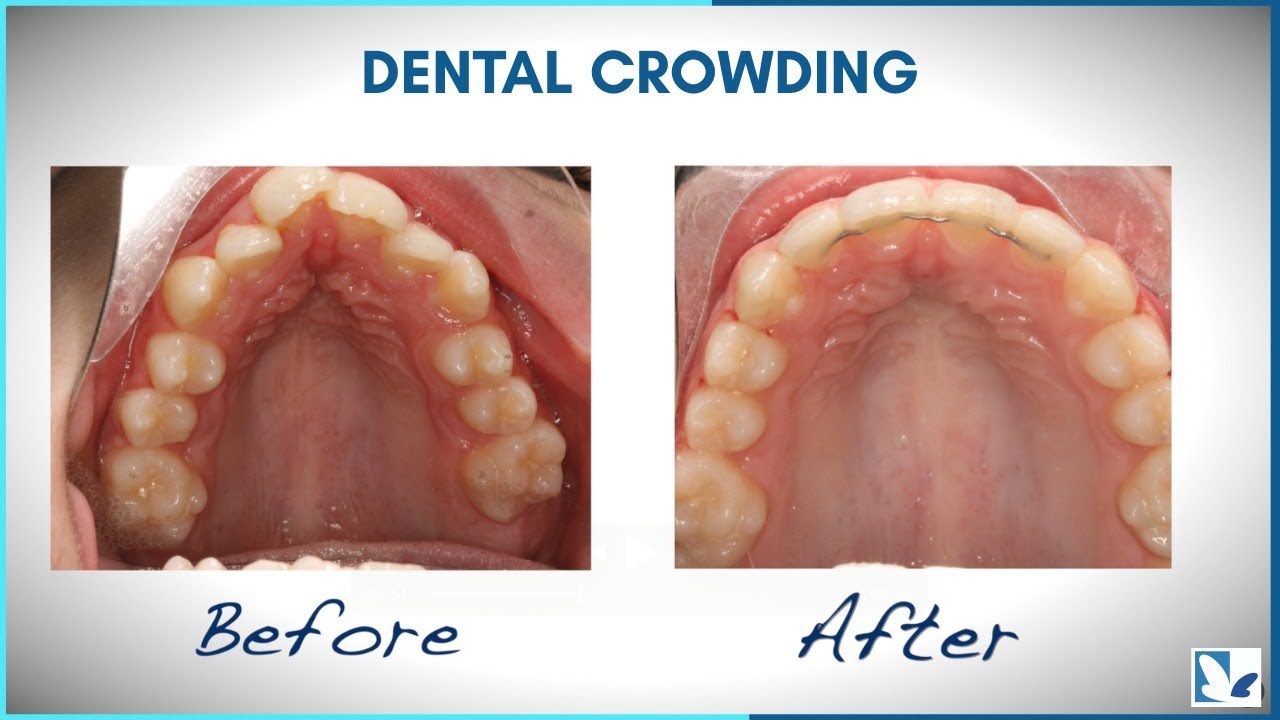How To Treat Moderately Severe Dental Crowding?