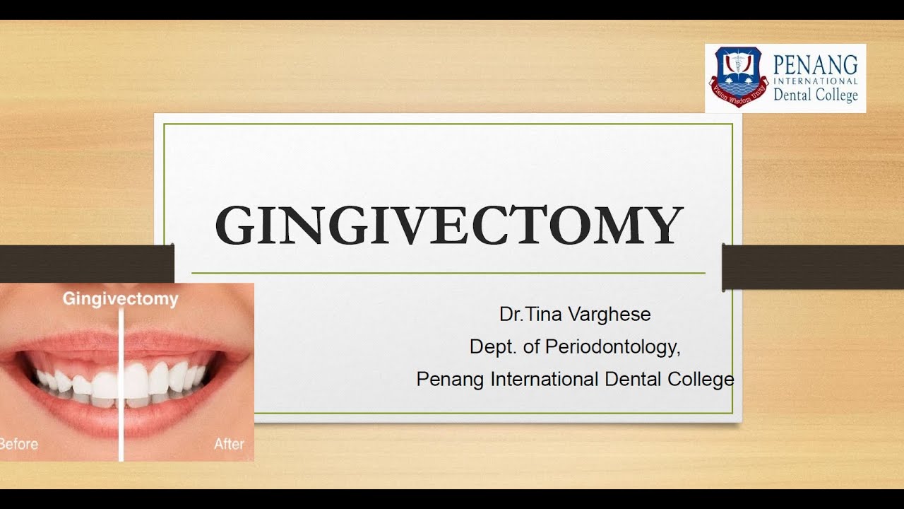 Gingivectomy