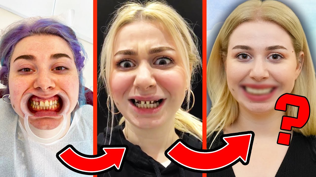 YENİ DİŞLERİME BAKKIIIIN ! 🥳 | Baştan Sona Diş Tedavi Sürecim 🦷