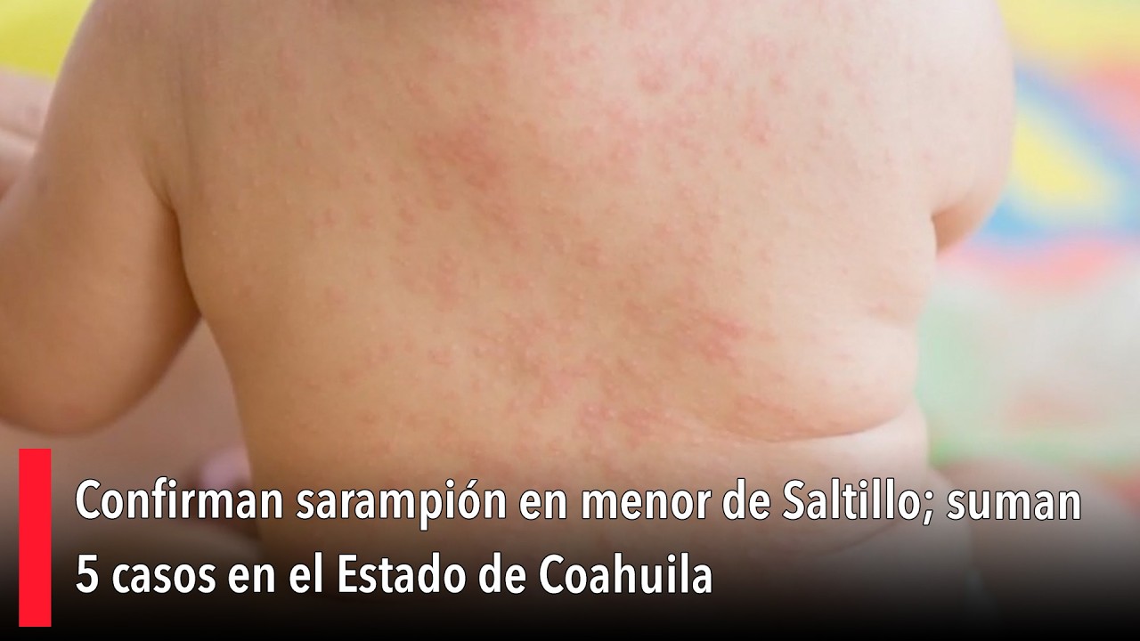 Confirman sarampión en menor de Saltillo; suman 5 casos en el Estado de Coahuila